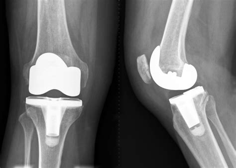 Knee replacement surgery video - In a unicompartmental (partial) knee replacement, only the damaged part of the knee is replaced. To Top. Last Reviewed. During knee replacement surgery, an orthopaedic surgeon will resurface your damaged knee with artificial components, called implants. The specific type of implant your surgeon uses will depend on …